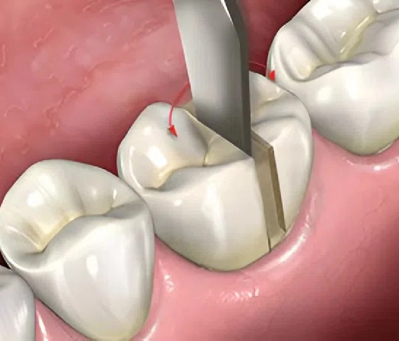 Tháo răng sứ bằng kỹ thuật rung siêu âm